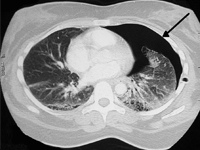 Recurrent pneumothorax in course of cystic fibrosis – treatment challanges. Case report.