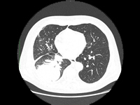 Possibilities of systemic treatment in patients with NSCLC after organ transplantation - case report and literature review