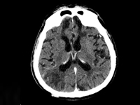 When your patient sleeps too much, disturbance of consciousness in the case of a geriatric patient – case report