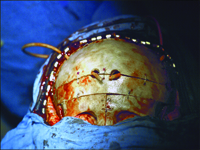 Cranio-facial clefts