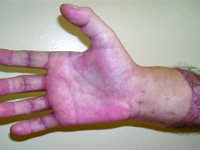 Socio-ethical aspects of upper limb transplantation