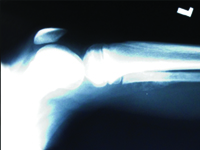 An unusual talent that appeared in Piotr Miszczyk treated for malignant sarcoma