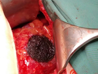 Application of water jet technology and argon plasma coagulation in nephron-sparing surgery for a kidney tumour – a case report.